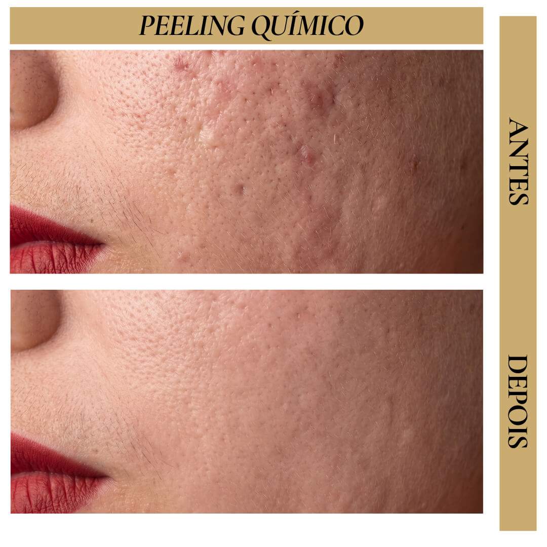 Antes e Depois - Peeling Químico